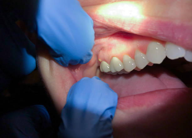 Best Emergency Dentist for Lost Fillings or Crowns in Und City, MO
